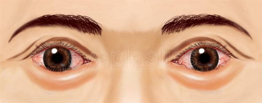 Clinical photograph of entropion — lower eyelid turning inward
