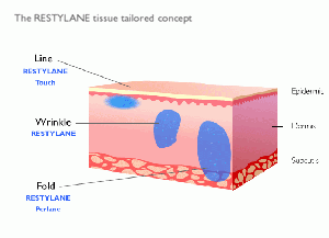 Illustration_how_restylane_works_other